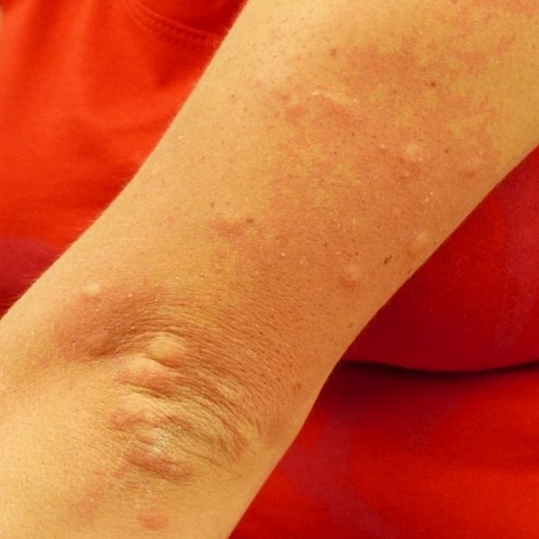 Eichenprozessionsspinner Allergie Symptome Hautausschlag Eichenprozessionsspinner Allergie Symptome Hautausschlag